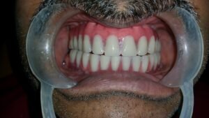 Read more about the article Full Mouth Dental Implants: A Proven Technology To Restore Your Smile & Oral Function