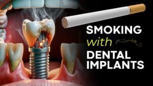 Read more about the article Can Smokers Get Dental Implants?