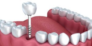 Read more about the article Are You Ready For Same Day Implants?  What Exactly Are Same Day Dental Implants? 