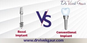 Read more about the article Benefits Of Basal Implants And Its Comparison With Conventional Implants