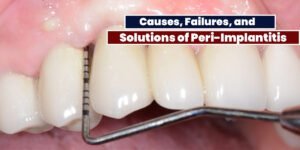 Read more about the article Causes, Failures, And Solutions Of Peri-Implantitis