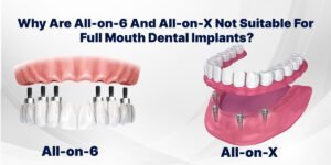 Read more about the article Why Are All-on-6 And All-on-X Not Suitable For Full Mouth Dental Implants?