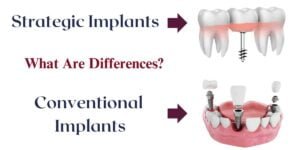 Read more about the article A Comparison Of Dental Implant Systems: Which Is Best? 