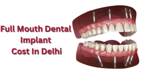 Read more about the article How Much Does A Full Mouth Dental Implant Cost In Delhi? 