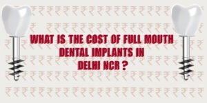 Read more about the article What Is The Cost Of Full Mouth Dental Implants In Delhi NCR?