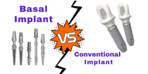 Read more about the article Comparing Traditional vs. Basal Implants: Which Is Right For You?