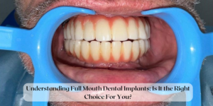 Read more about the article Understanding Full Mouth Dental Implants: Is It The Right Choice For You?