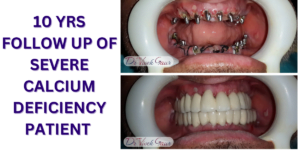 Read more about the article Patient Case Study: Transformative Dental Implant Care by Dr. Vivek Gaur