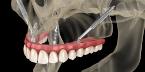 Read more about the article Navigating Complex Cases: How Zygomatic Implants Offer Solutions For Patients With Severe Bone Loss 