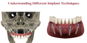 Read more about the article Understanding Different Implant Techniques: A Comprehensive Guide