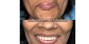 Read more about the article 48-Hour Smile Transformation How Dr. Vivek Gaur’s Technique Compares To Others