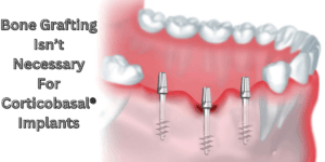 Read more about the article Why Bone Grafting Isn’t Necessary For Corticobasal® Implants