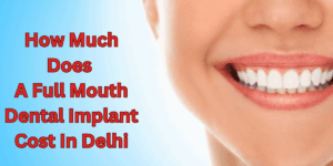 Read more about the article How Much Does A Full Mouth Dental Implant Cost In Delhi