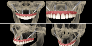 Read more about the article Why Zygomatic Implants Are A Game-Changer For Patients With Severe Bone Loss