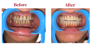 Read more about the article Full Mouth Dental Implants: The Ultimate Solution For Tooth Replacement In Delhi NCR