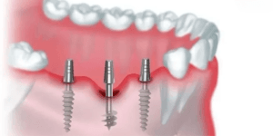 Read more about the article Understanding Basal Implants: A Revolutionary Approach