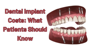 Read more about the article Dental Implant Costs: What Patients Should Know
