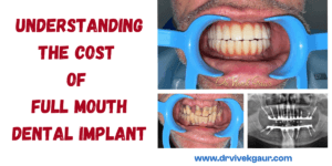 Read more about the article Understanding The Cost Of Full Mouth Dental Implant