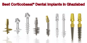 Read more about the article Best Corticobasal® Dental Implants In Ghaziabad