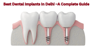 Read more about the article Best Dental Implants In Delhi –A Complete Guide
