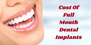 Read more about the article Cost Of Full Mouth Dental Implants