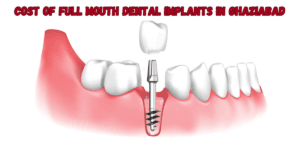 Read more about the article Cost Of Full Mouth Dental Implants In Ghaziabad