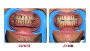 Read more about the article How Corticobasal® Implants Are Perfect For Patients with Limited Bone Structure