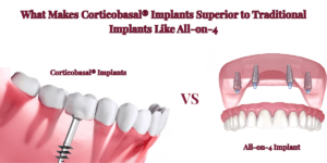 Read more about the article What Makes Corticobasal® Implants Superior to Traditional Implants Like All-on-4