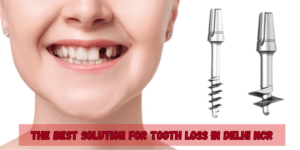 Read more about the article Corticobasal® Implants: The Best Solution for Tooth Loss in Delhi NCR