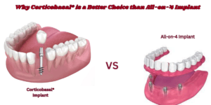 Read more about the article Permanent Dental Implants in Delhi: Why Corticobasal® is a Better Choice than All-on-4 Implant