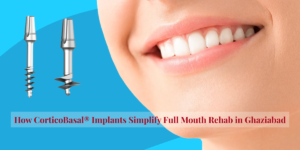 Read more about the article How CorticoBasal® Implants Simplify Full Mouth Rehab in Ghaziabad