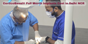 Read more about the article Cost Breakdown: CorticoBasal® Full Mouth Implants in Delhi NCR