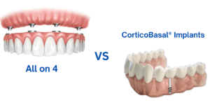 Read more about the article Allon4 vs. CorticoBasal® Implants: Better Full Mouth Solutions in Ghaziabad