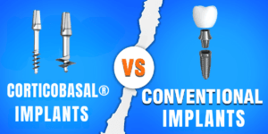 Read more about the article How Do CorticoBasal® Implants Compare to Conventional Implants?