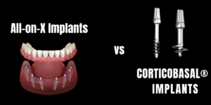 Read more about the article CorticoBasal® vs All-on-X Implants: Why Dr. Vivek Gaur’s Technique is Superior for Delhi NCR Patients