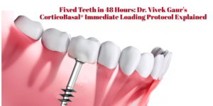 Read more about the article Fixed Teeth in 48 Hours: Dr. Vivek Gaur’s CorticoBasal® Immediate Loading Protocol Explained