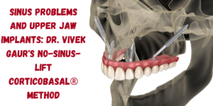 Read more about the article Sinus Problems And Upper Jaw Implants: Dr. Vivek Gaur’s No-Sinus-Lift CorticoBasal® Method
