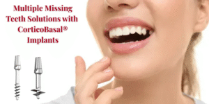 Read more about the article Multiple Missing Teeth Solutions with CorticoBasal® Implants