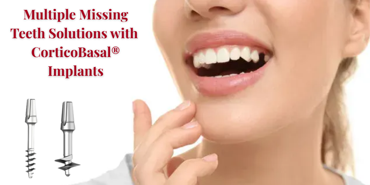 Read more about the article Multiple Missing Teeth Solutions with CorticoBasal® Implants