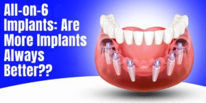 Read more about the article All-on-6 Implants: Are More Implants Always Better? The Strategic Implant Perspective