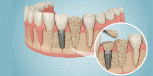 Read more about the article Bone Grafts vs Graft-Free Implant Solutions: What Should You Choose?