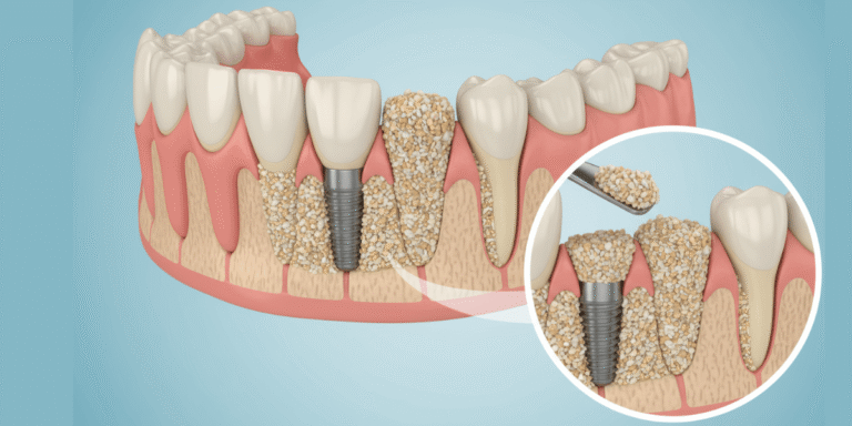 Read more about the article Bone Grafts vs Graft-Free Implant Solutions: What Should You Choose?
