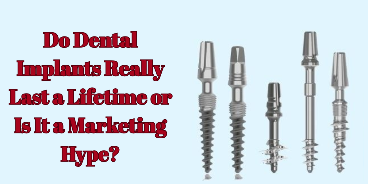 You are currently viewing Do Dental Implants Really Last a Lifetime or Is It a Marketing Hype?