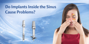 Read more about the article Do Implants Inside the Sinus Cause Problems?