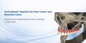 Read more about the article Corticobasal® Implants for Post-Cancer and Resection Cases: Advanced Jaw Rehabilitation Now Available in Delhi NCR