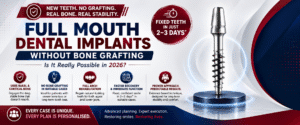Read more about the article Full Mouth Dental Implants Without Bone Grafting: Is It Really Possible in 2026?