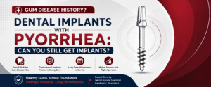 Read more about the article Dental Implants for Patients with Periodontal Disease: Can You Still Get Implants with Pyorrhea?