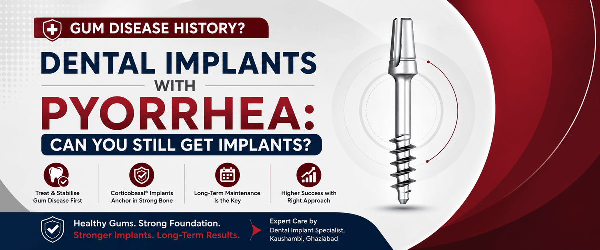 You are currently viewing Dental Implants for Patients with Periodontal Disease: Can You Still Get Implants with Pyorrhea?